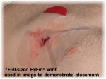 Hyfin Vent Compact Chest Seal Twin Pack - Image 7